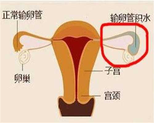 子宫内膜异位症是常见的妇科疾病，会有什么危
