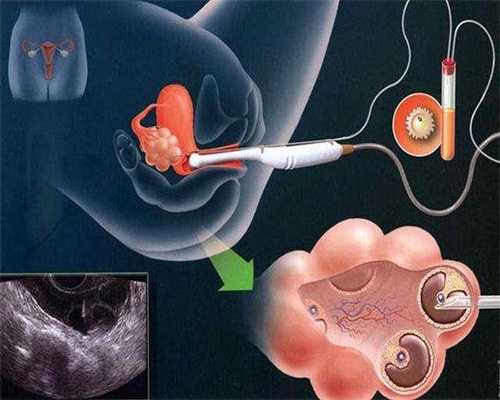控制输卵管炎症的发生是养生殖道的关键