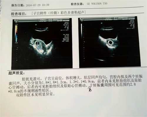 广州代孕哪家靠谱-做试管婴儿，该如何预防腹水？什么是腹水？